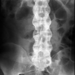 Diagnosis and Treatment of Ankylosing Spondylitis in West Hills, CA