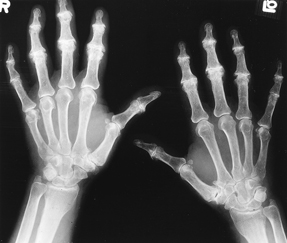 Osteoarthritis diagnosis in West Hills, CA | Dr. Nazanin Firooz