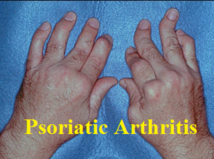Psoriatic Arthritis | West Hills, CA | Dr. Nazanin Firooz