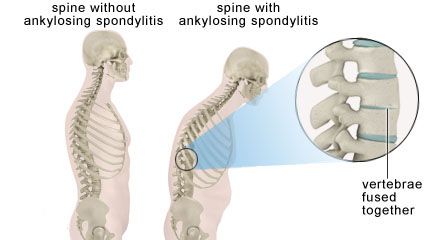 Signs and Symptoms of Ankylosing Spondylitis in West Hills, CA