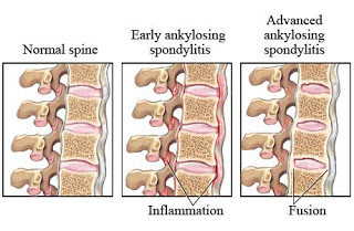 Diagnosis and Treatment of Ankylosing Spondylitis in West Hills, CA
